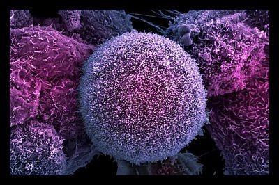 Cancer_in_the_Developing_World