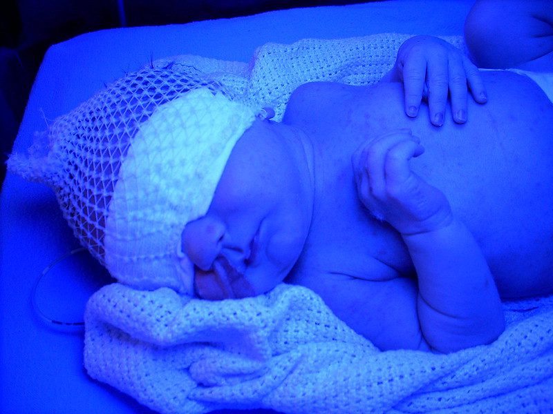 Neonatal Jaundice
