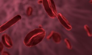 sickle cell disease in Tanzania