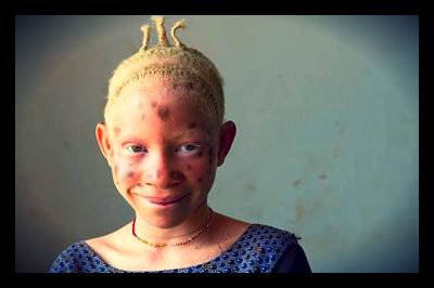 Tanzanian_Albinos_in_danger