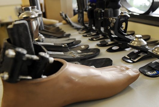 prosthetics for the poor